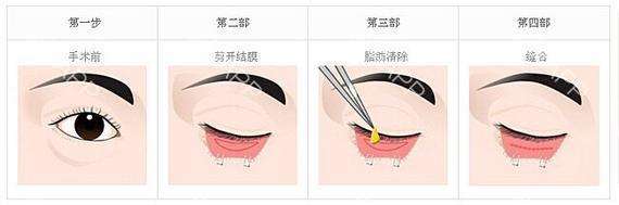 上海做去眼袋手術一般多少錢