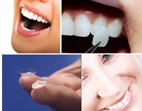 美萊醫療美容牙齒貼面修復能維持多久