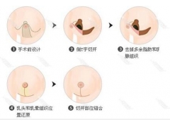 乳頭過大怎么辦,上海做乳頭縮小術選哪種好