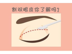 上海做雙眼皮手術要多少錢，貴不貴