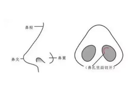 上海鼻頭鼻翼縮小注意事項有哪些
