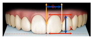 中切牙正常長寬比為75－80％