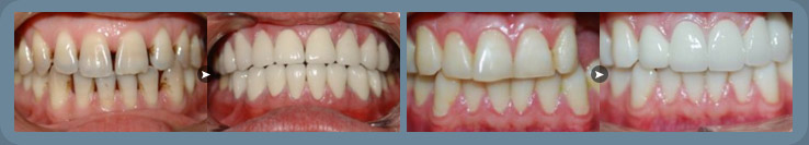 全瓷牙牙齒矯正前后對比
