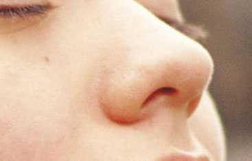 鼻中隔軟骨隆鼻