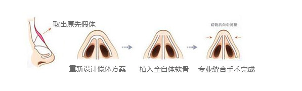 假體隆鼻修復示意圖