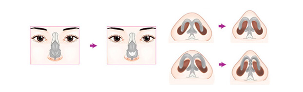 鼻頭縮小術手術過程