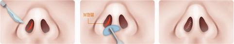 膨體隆鼻過程