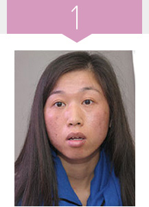 美萊祛斑治療前色斑嚴重