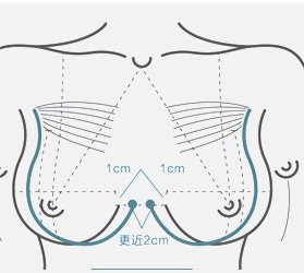 美萊胸部整形四大技術特點