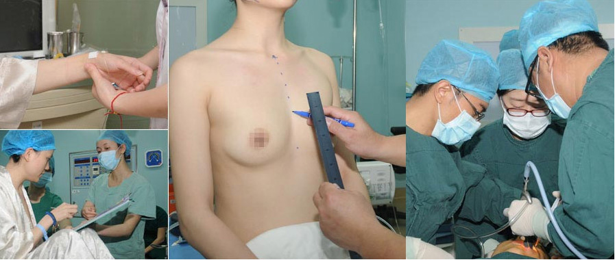 美萊胸部整形術中專業操作