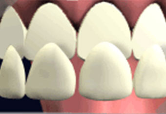 美萊修復牙貼面醫生技術嚴苛要求