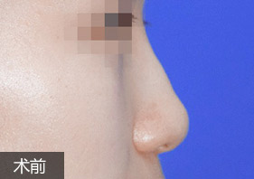 綜合隆鼻案例