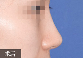 綜合隆鼻案例