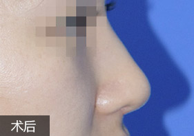 經典假體隆鼻案例
